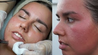 MY ALLERGIC REACTION TO DERMAPEN [upl. by Desiri]