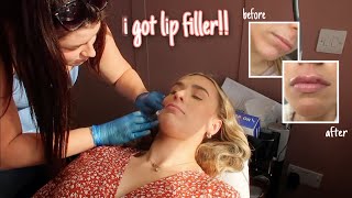 I GOT LIP FILLER FOR THE FIRST TIME 05 ml natural lips healing process start to finish [upl. by Bowlds]