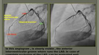 Coronary Angiography 2018 [upl. by Tivad]