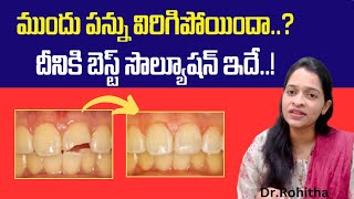 పన్ను విరిగిందా ఇలా చేయండి  How to treat front tooth fracture  drRohithaMaganti [upl. by Leicam]