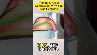 Rhinitis amp Nasal Congestion Why You Cant Breathe rhinitis acnnlifearena shorts [upl. by Suriaj]