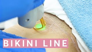 Laser Hair Removal Bikini THIS is how it works [upl. by Nidorf]