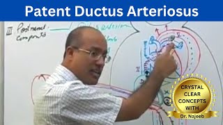 Patent Ductus Arteriosus  PDA [upl. by Marcellus]