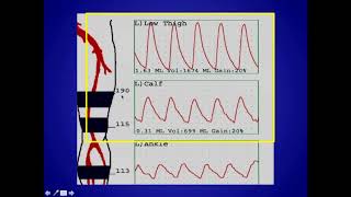 How to Perform and Interpret Peripheral Arterial Doppler Examinations [upl. by Narayan]