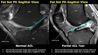 MRI Knee Normal Vs ACL Tear  Anterior Cruciate Ligament Tears  Sports Injuries Imaging Cases [upl. by Philly]