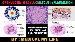 GRANULOMA  GRANULOMATOUS INFLAMMATION  Types Of Chronic Inflammation [upl. by Bornie256]