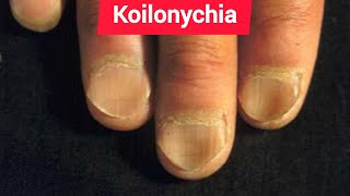 Leukonychia Platynychia and Koilonychia in Chronic iron deficiency anemia [upl. by Atinauq]