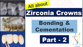 Zirconia Crowns  CEMENTATION vs BONDING [upl. by Ymeon530]