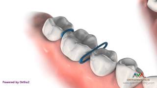 Orthodontic Separator or Spacer  Rubber ORings [upl. by Buddie]