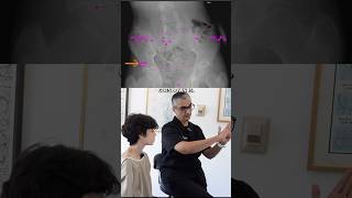 9 Years Limping and SEVERE Back Pain  Coccyx amp Pelvis Adjustment shorts [upl. by Kimmi824]