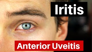 Iritis  What is Anterior Uveitis Doctor Explains [upl. by Oby668]