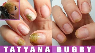 How I Cured My Nails  Shocking Experience  Restoring Nails from Bacteria [upl. by Omsoc]