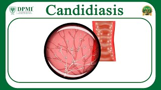 Candidiasis What is Candidiasis Candida Species– Morphology Pathogenesis of Candida Albicans [upl. by Krys]