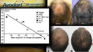 Dutasteride Phase 3 Clinical Trial 25mg Grows Hair Faster 80 Scalp DHT [upl. by Saoj288]