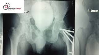 Pre and PostOp Imaging Posturethroplasty For Pelvic Fracture Posterior Urethral Distraction Defect [upl. by Saw]