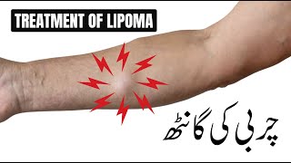 Best Treatment of Lipoma  Lipoma Ganth ka best ilaj  Dr Muhammad Faisal [upl. by Tiff]