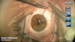 Modified Seipser Sliding Knot for Iris Suturing Ike Ahmed [upl. by Landa]