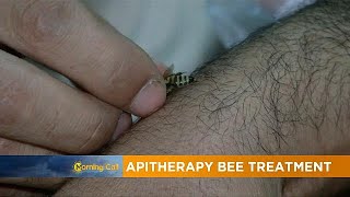 Apitherapy bee treatment for pain The Morning Call [upl. by Lawford]