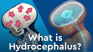 What is Hydrocephalus and Why Does Fluid Build Up in the Brain [upl. by Hermon]