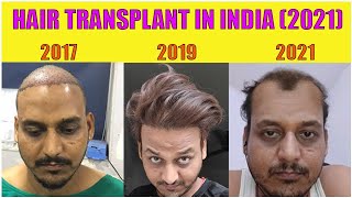 Hair Transplant result after 4 years 2021 INDIA [upl. by Adnhoj]