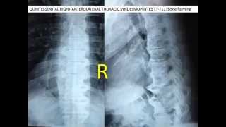 Lecture on DISH diffuse idiopathic skeletal hyperstosis of the spine [upl. by Assyli443]