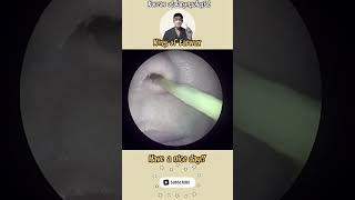 귀지형 콧물 부비동염 축농증 비염 코청소 이비인후과 rhinorrhea rhinitis sinusitis asmr [upl. by Martin]