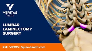 Lumbar Laminectomy Surgery [upl. by Brady]