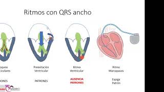 15  Taquicardia ventricular TV [upl. by Eralc]