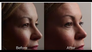 Tixel skin resurfacing treatment results Did it work [upl. by Atse]