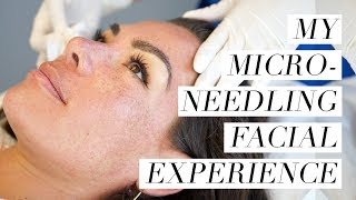 My Microneedling Facial Experience [upl. by Redla]