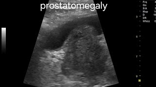 Grades or grading of prostatomegaly or benign hypertrophy prostate on ultrasound [upl. by Agnimod]