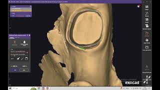 EXOCAD DE DİJİTAL ÖLÇÜ DE KOLE AÇMI [upl. by Elysee]