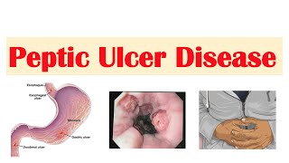 Peptic Ulcer Disease Gastric vs Duodenal Ulcers  Causes Symptoms Diagnosis Treatment [upl. by Elokcin20]