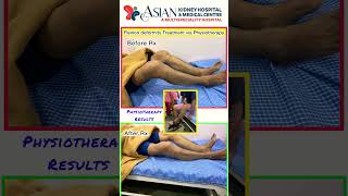 Flexion deformity treatment shorts flexiondeformity deformity [upl. by Shyamal]