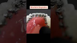 brackets linguales odonto brackets ortodoncia parati viral dentista dienteschuecos [upl. by Snebur]