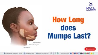 Mumps Last  How Long does Mumps Last  mumps shorts viralvideo [upl. by Adanar]