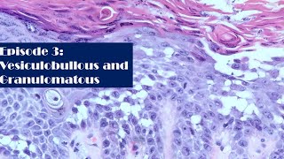 Episode 3 Vesiculobullous and Granulomatous [upl. by Nevad]