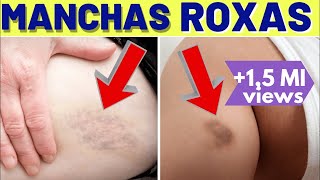 CAUSAS DE MANCHAS ROXAS NO CORPO devo me PREOCUPAR [upl. by Africah191]