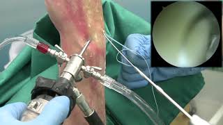 Indirect Scapholunate Ligament Repair All Arthroscopic [upl. by Llerahs357]