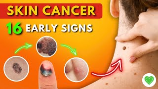 16 Early Signs of Skin Cancer You Should Never Ignore  Melanoma  Skin Cancer Symptoms [upl. by Anabel14]