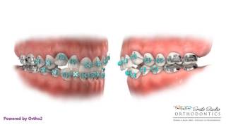 Class I Crowding  Braces  Orthodontic Treatment [upl. by Eifos]