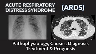 Acute Respiratory Distress Syndrome ARDS  Pathophysiology Causes Diagnosis and Management [upl. by Benedick698]