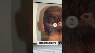 Sichere vs unsichere Spenderbereiche bei der Haartransplantation [upl. by Rivalee]