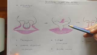 Cleft lippart 4 Bilateral cleft lip [upl. by Tunk713]