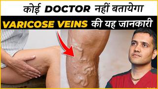 Real Information About Varicose Veins Treatment That No Doctor Will Tell You  Dr Gaurav IR [upl. by Tik]