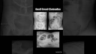 Small bowel obstruction kasus 2 xray radiology röntgen obstruction [upl. by Euphemiah215]