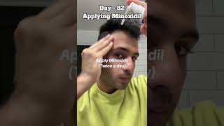 Day82 Applying Minoxidil 5 haircare hairloss minoxidil minoxidilresult [upl. by Eirrehs]