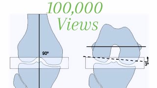 Total Knee Replacement Step by Step [upl. by Gilud]