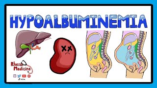 Hypoalbuminemia  Functions of Albumin in the Body  Pathophysiology of Hypoalbuminemia [upl. by Justus]