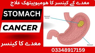 Stomach Cancer Symptoms amp Miasmatic Treatment in Homeopathy stomachcancer hpylori [upl. by Iadahs]